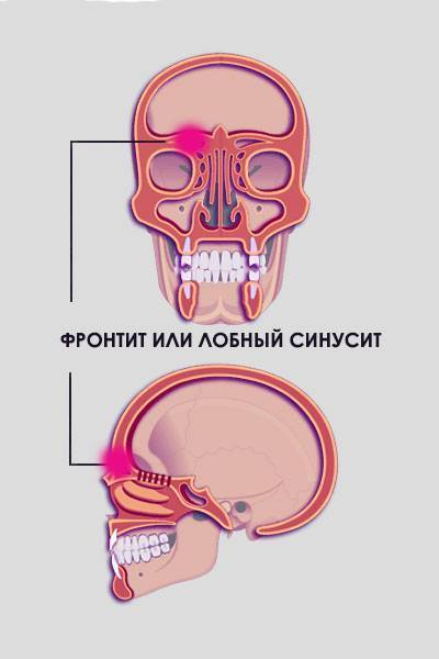 Как лечить фронтит?