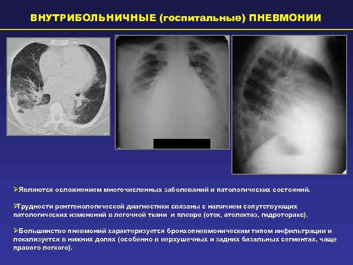 Глава 22. пневмония
