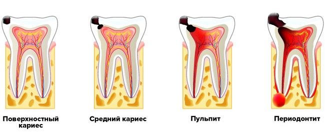 Признаки, симптомы и лечение пульпита зуба