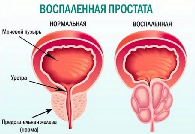 Воспаление простаты: симптомы и лечение