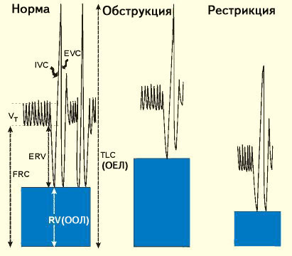 Что такое спирография и как ее проводят