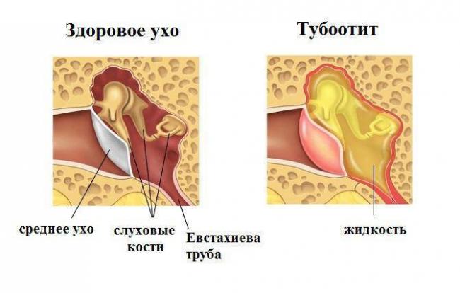 Острый отит, причины и лечение острого отита среднего уха без температуры, причины и последствия