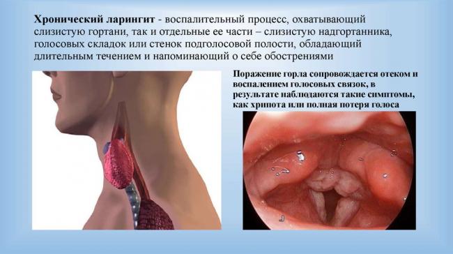 Виды хронического ларингита, причины, симптомы и лечение