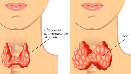 Все о зобе и его лечении