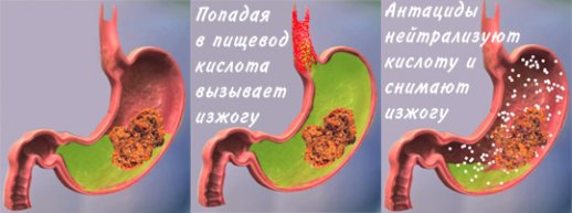 Рацион питания при гастрите с повышенной кислотностью