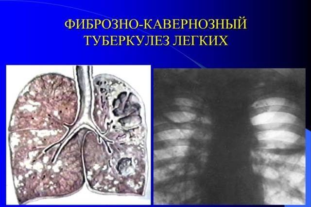 Фиброзно-кавернозный туберкулез легких: сколько с ним живут и как лечат?