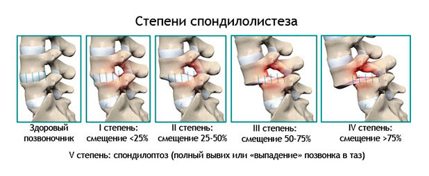 Смещение позвонков поясничного отдела — симптомы и лечение
