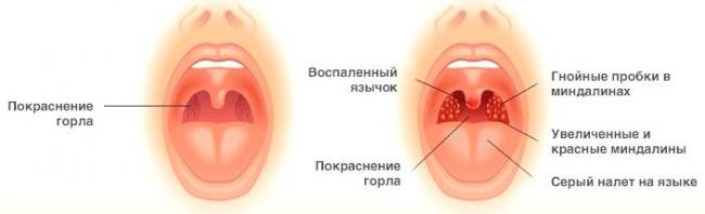 Односторонняя боль в горле при глотании