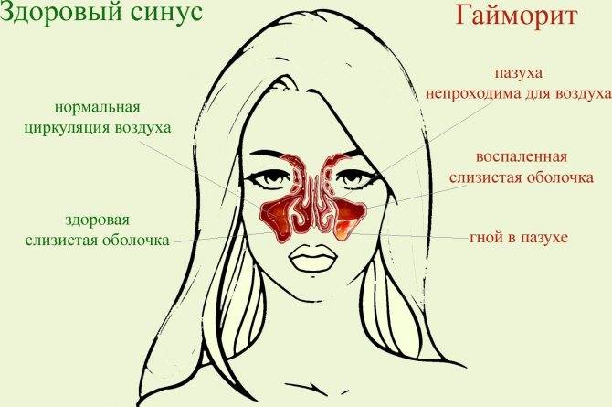 Прогревание носа при гайморите