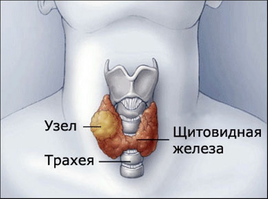 Зоб узловой