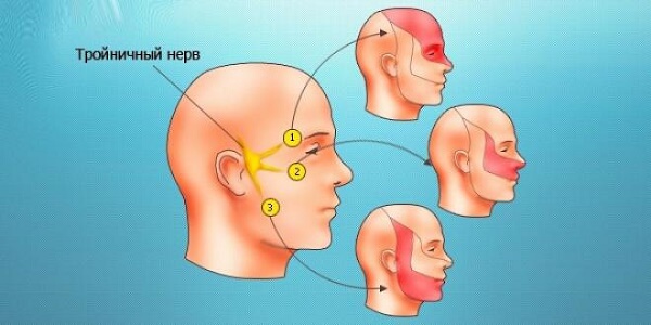 Неврит и невралгия тройничного нерва: причины, симптомы и лечение