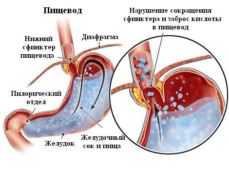 Диета при рефлюкс эзофагите