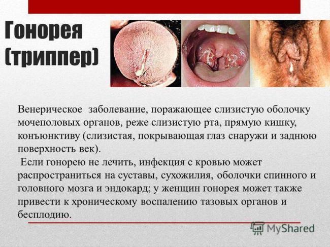 Заболевания, передающиеся половым путём