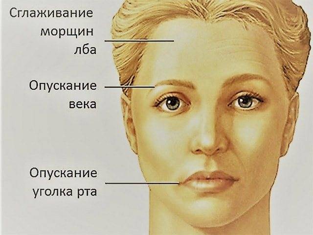 Лечение невралгии тройничного нерва