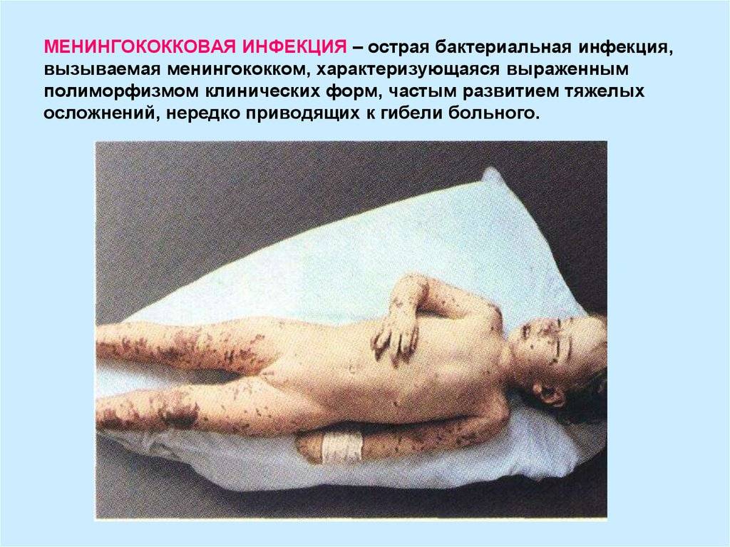 Менингококцемия у детей и взрослых. симптомы. осложнения. молниеносная форма. неотложная помощь. фото