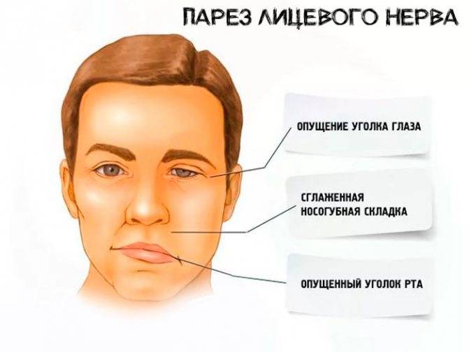 Как снять симптомы и острую боль: способы лечения невралгии лицевого тройничного нерва