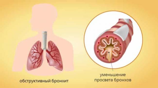 Бронхит у ребенка – лечение в домашних условиях народными средствами