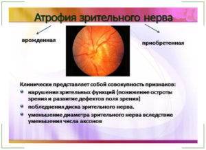 Лечение атрофии зрительного нерва народными средствами