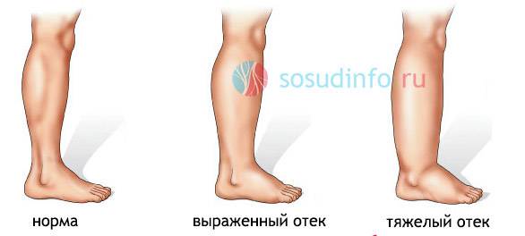 Лимфостаз нижних конечностей
