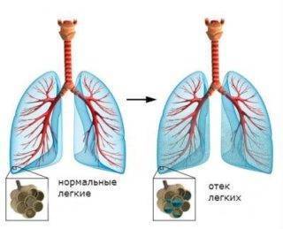 Кашель хрипы при выдохе у взрослого