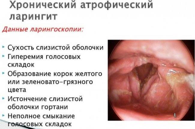 Ларингит у взрослых — симптомы и лечение, что это такое, фото, первые признаки ларингита
