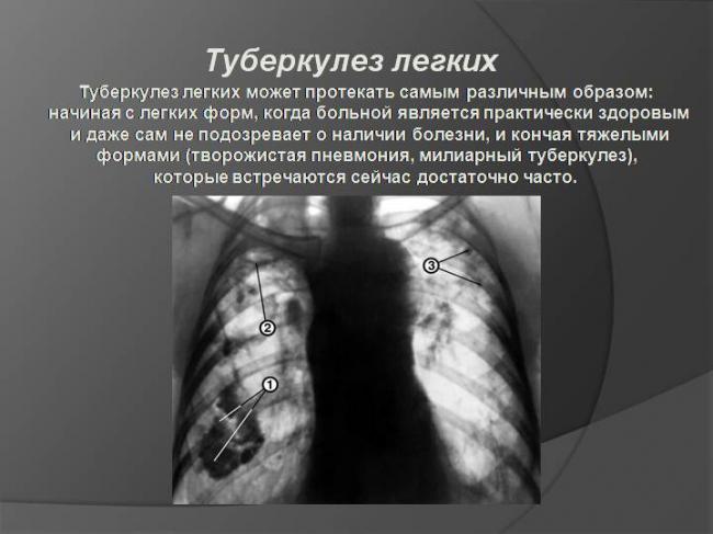 Основные различия между пневмонией и туберкулезом