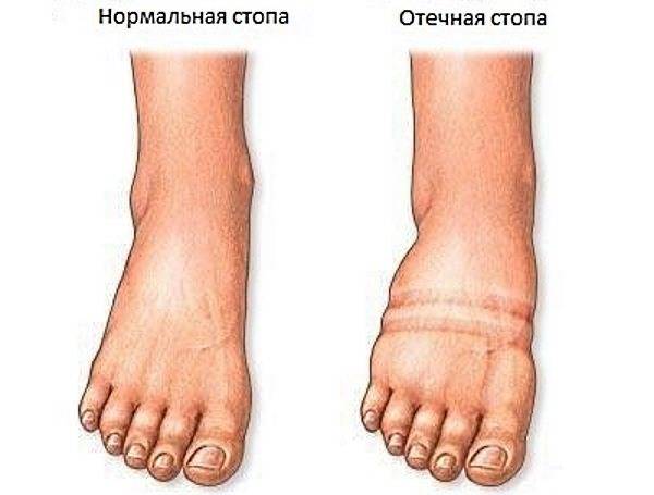 Лимфостаз