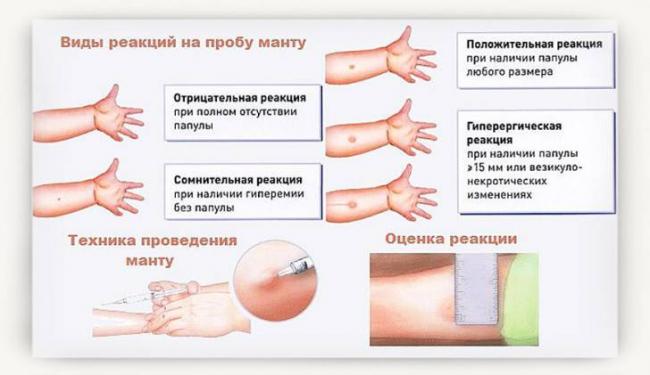 Отрицательная манту(((( - запись пользователя альфия (russia1976) в дневнике - babyblog.ru