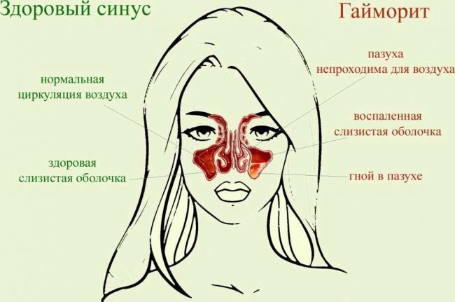 Как вылечить гайморит в домашних условиях у взрослых народными средствами?