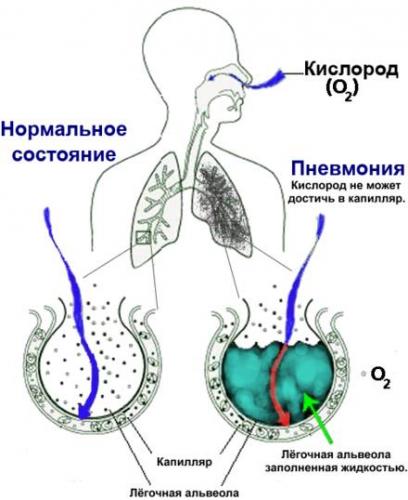 Что показывает анализ крови при пневмонии?