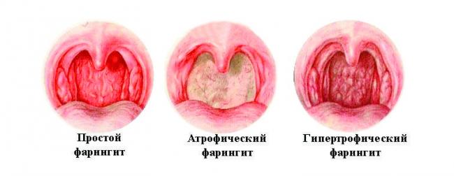 Ларингит. описание, симптомы, причины и лечение ларингита