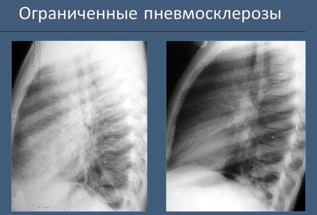 Как лечить диффузный пневмосклероз