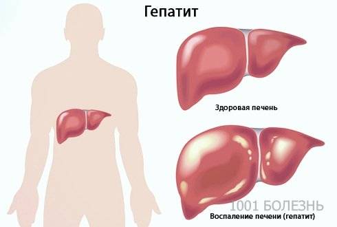 Диета при гепатите аутоиммунном