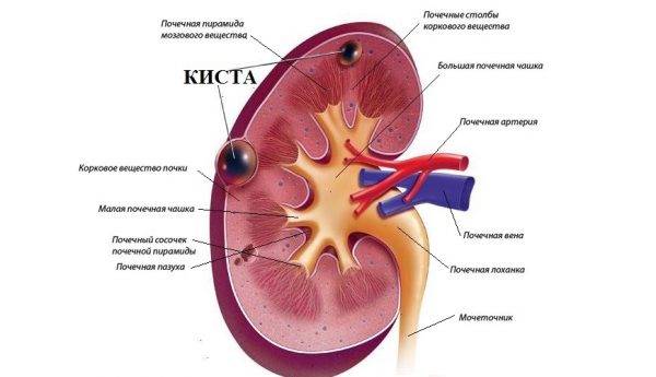 Причины, симптомы и лечение кисты правой и левой почки