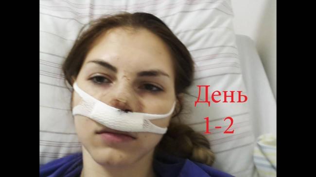 Септопластика носа в москве, цены, до и после операции выпрямления носовой перегородки