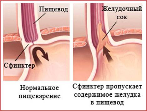 Что такое недостаточность кардии желудка, сиптомы и лечение