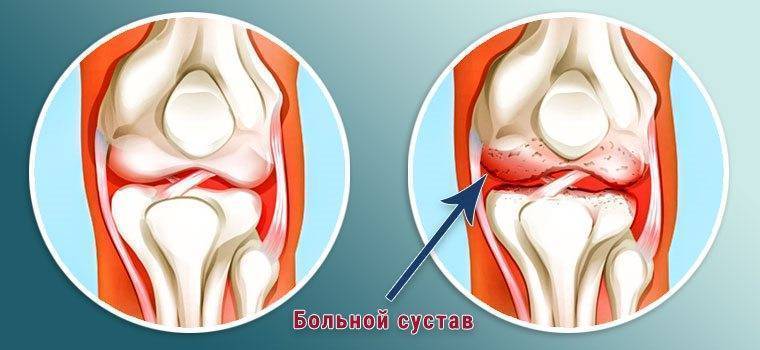 Кетопрофен Ketoprofen инструкция по применению
