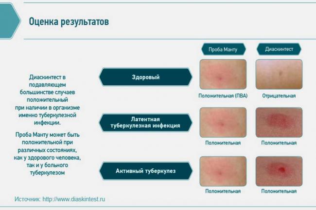 Папула при диаскинтесте: размеры и значение, расшифровка, фото