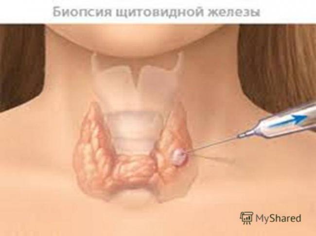 Все о зобе и его лечении