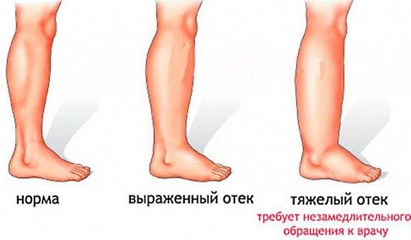 Причины и формы лимфостаза – опасности лимфостаза и прогноз