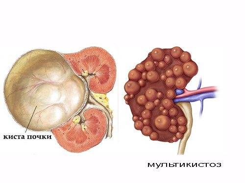 Может ли рассосаться киста на почке