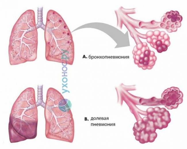 Пневмония – симптомы и признаки у взрослых и детей