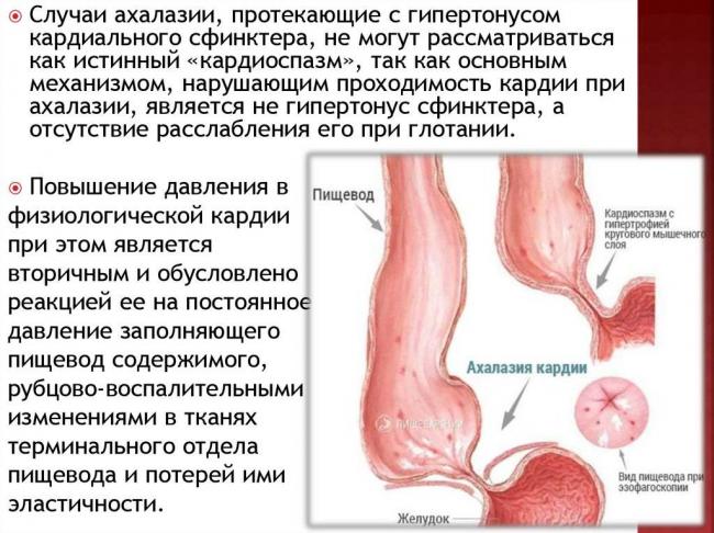 Ахалазия кардии: симптомы и лечение