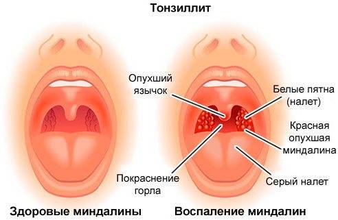 Как победить хронический тонзиллит – схема лечения миндалин