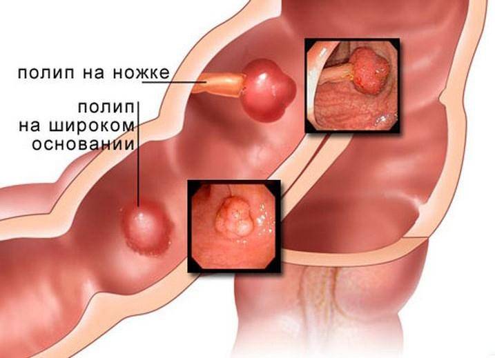 Обзор эффективных мазей от зуда, боли и трещин в заднем проходе. зуд заднего прохода лечение.