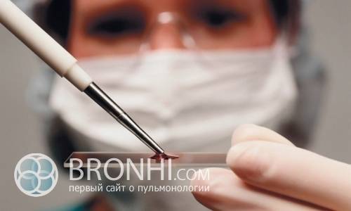 Общий анализ крови при туберкулезе лёгких