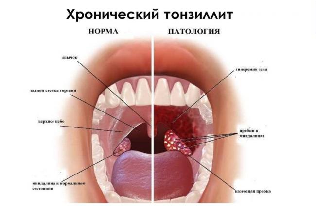 Как протекает острый простатит?