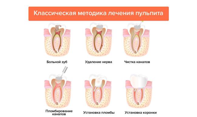 Пульпит зуба: симптомы болезни, методики и этапы лечения