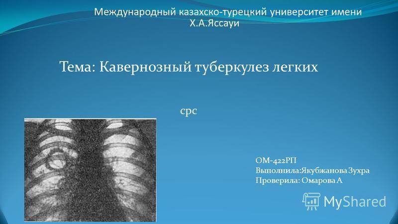 Кавернозный туберкулез не приговор: современные методы лечения
