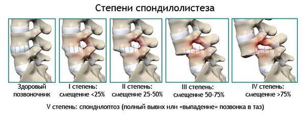 Советы по лечению смещения позвонков поясничного отдела